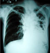 20110324115316-tuberculosis.jpg