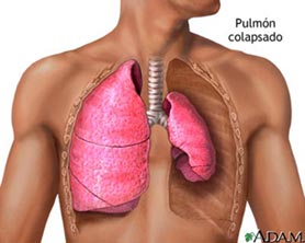 20110325213752-pulmon.jpg