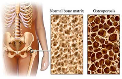 20100917135556-osteoporosis-web.jpg