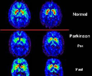 Hematología 2013 presentará estudio sobre tratamiento del Parkinson