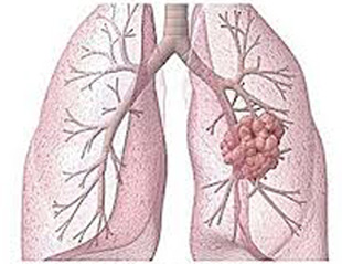 20130608131520-pulmon.jpg